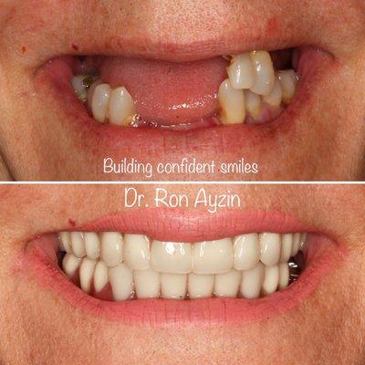 Brand new smile and confident life with implants and all-on-x