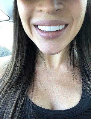 My beautiful smile thanks to Dr Carpenter and his team!