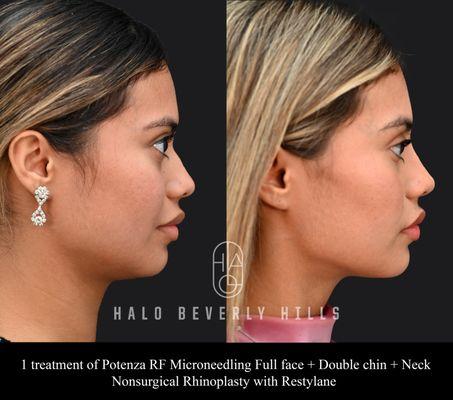 Potenza RF Microneedling and Nonsurgical Rhinoplasty