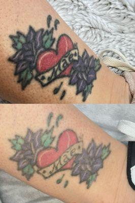 Laser Tattoo Removal