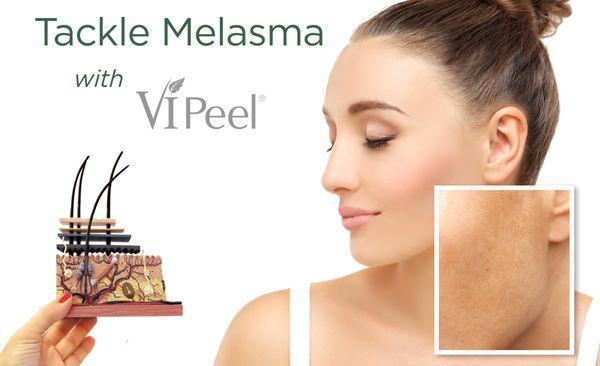 VI Peels are one of The Best in the industry!