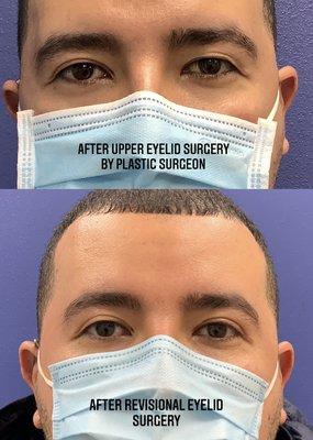 Dr. Iyengar regularly fixes eyelid surgery performed by plastic surgeons who are not eyelid specialists.