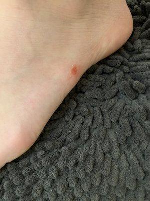 Another picture of the skin scrapped off the side of my foot