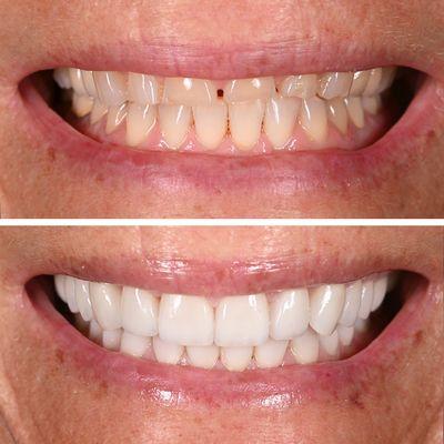 Natural smile makeover with Veneers