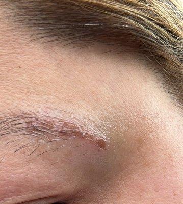 Chemical burn , eyebrow