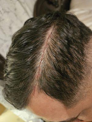 Cut on scalp