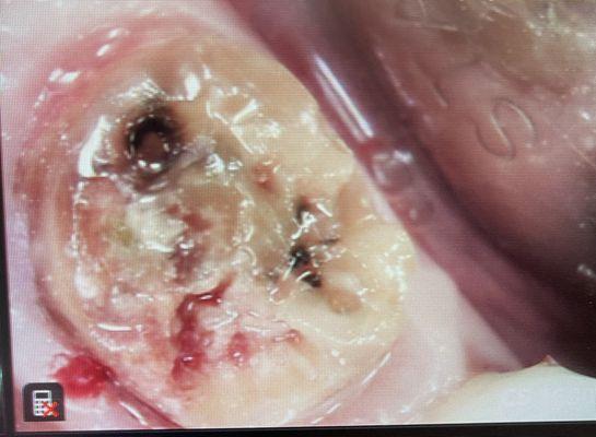 This is what the dentist saw after he removed the defective crown. My molar was completely destroyed by decay!