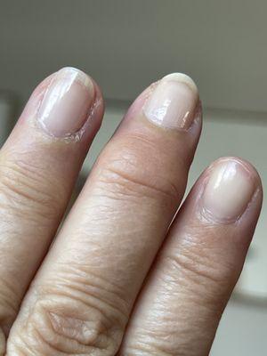 Peeled/chipped index finger and shredded cuticles