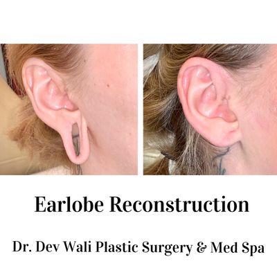 Earlobe Reconstruction by Dr. Wali