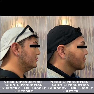 Liposuction - Chin Liposuction Surgery - Dr Tuggle - Before-After