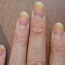 WARNING! this could happen to you...they do NOT use an autoclave or barbicide to sanitize their nail tools.  This could be your nails!