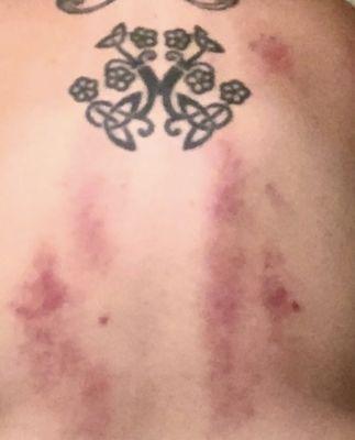 Gua Sha results. Looks brutal feels amazing and helps so much. It's the best!!