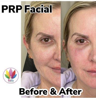 PRP treatments in Riverside California for Skin