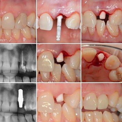 CeraRoot 34 was used because the socket of the lateral incisor was big & the CeraRoot 12 would not have as good stability. Happy patient