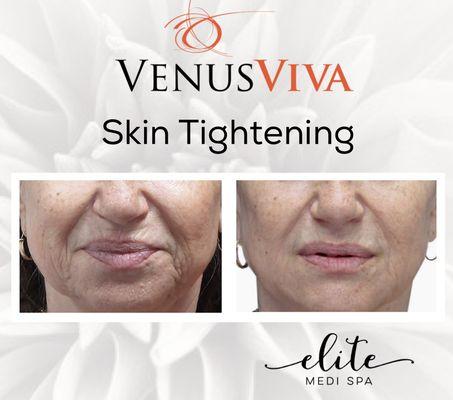 Skin tightening with Venus Viva