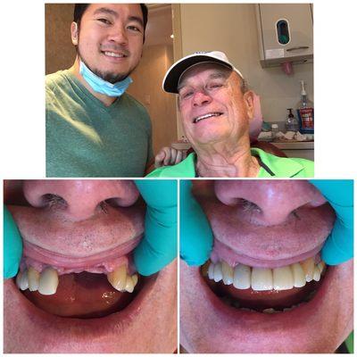 3 implants placed in the front to bring Mr. Davis' smile back! And ability to eat corn..