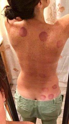 Cupping