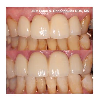 With our organic in office whitening system we managed to get a wonderful whiter result for these stained& aged teeth with NO sensitivity!