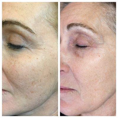 Lumecca IPL treatment for sun damage