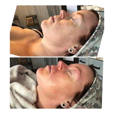 VitaBrite peel Before and After 
$85