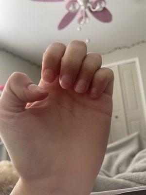 ripped pinky nail from removal