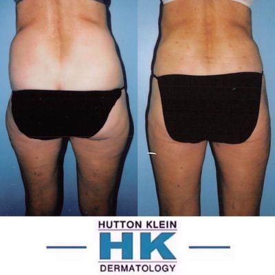 Tumescent Liposuction B/A of the Hips and Outer Thighs by Dr. Jeffrey Klein at HK Dermatology.