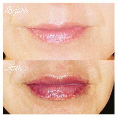 Before & After of Lip Filler Procedure.