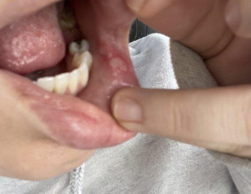 Canker sores resulting from a tooth extraction