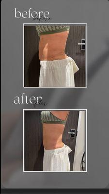 Fat Cavitation results after 1 session