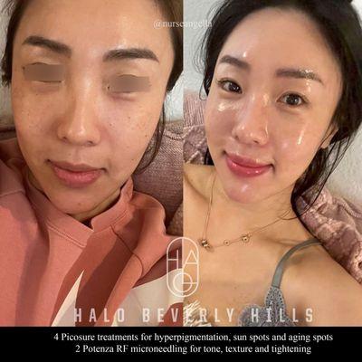 Picosure + Potenza microneedling (Blended energy) for texture, tone and tightening. Amazing before and after from our beautiful patient!