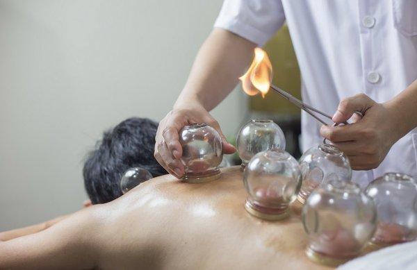 fire cupping