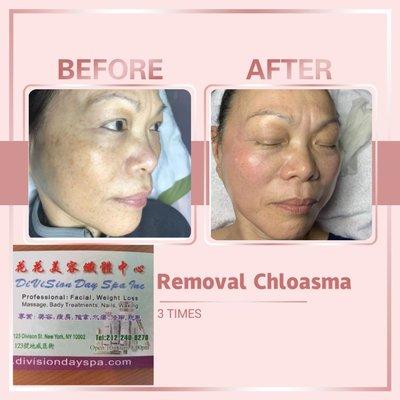 REMOVAL Chloasma 3 TIMES