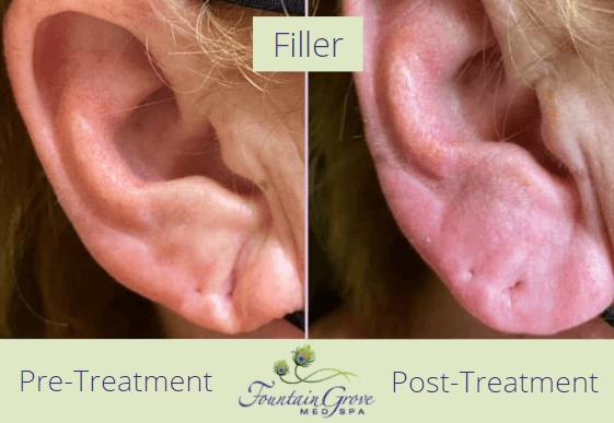 Filler Patient, Before and After!