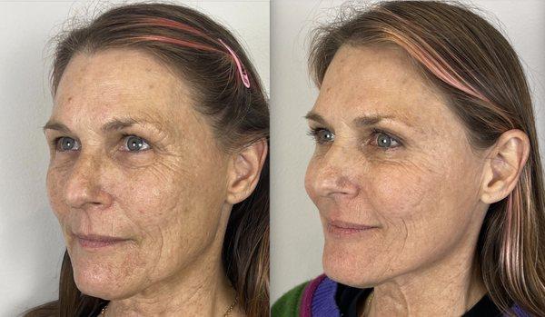 Before and after injections at Well Medical Spa