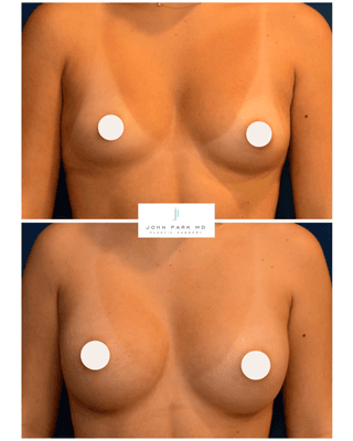 Breast Augmentation with Mentor Silicone Implants, Liposuction of the Axilla