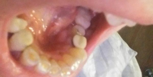 tooth was not prepped to match the height of surrounding teeth nor space made to seat the cap into the gum