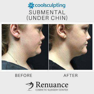 CoolSculpting at Renuance Cosmetic Surgery Center & Medical Spa in Murrieta, CA