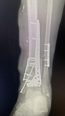 Front view of my new hardware additions to my leg bones.