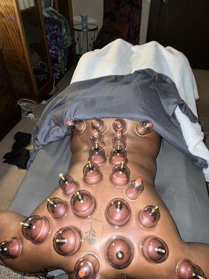 Cupping Therapy