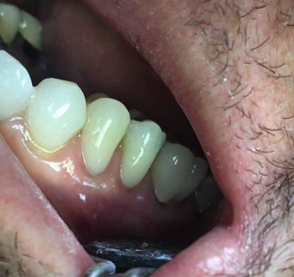 Natural looking fillings on premolars after severe wear/sensitivty from brushing too hard