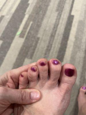 Bad pedicure