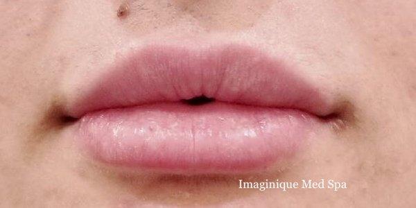 Post Lip Augmentation