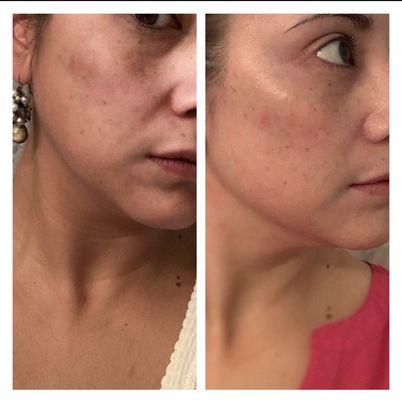 Left: melasma before my first Perfect Peel. Right: after the peel. Less discoloration, firmer skin, tighter pores.