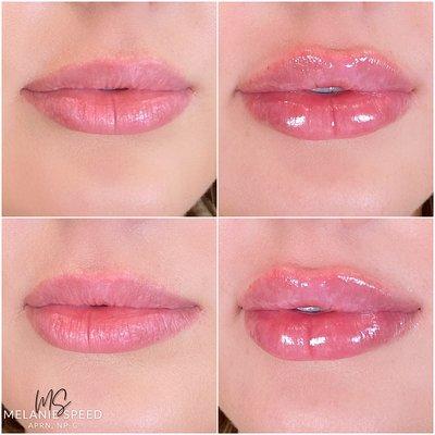 Before and after lip augmentation by Melanie Speed, APRN, NP-C