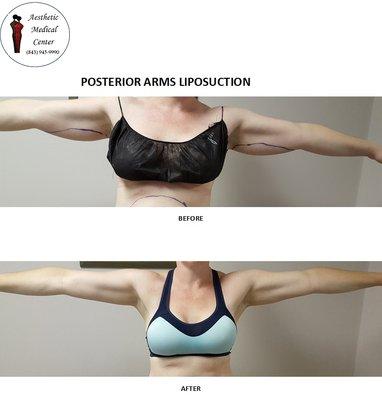 Posterior Arms Liposuction