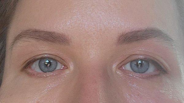 Upper eyelids 8 days after the procedure.