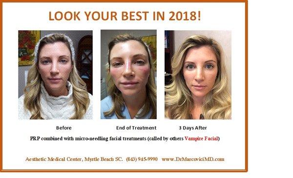 Facial Rejuvenation with Microneedling and PRP for a glowing, younger and healthier looking skin...