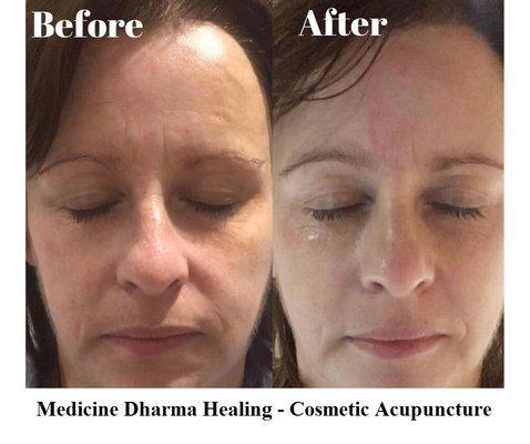 Face Cosmetic Acupuncture