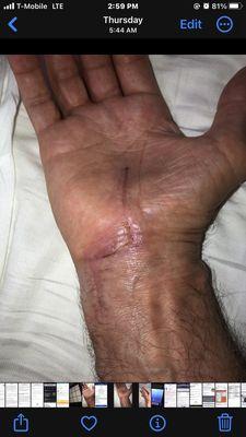 3 weeks post surgery UCSF right hand 2nd release in 13 years.