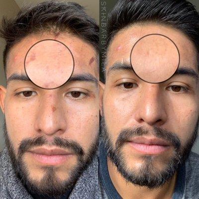 Before and after's from a Vitamin A Peel